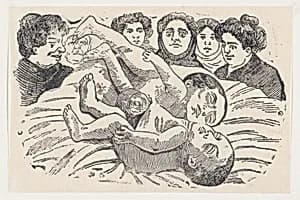 Siamese Twins by José Guadalupe Posada
