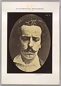 Figure 15: Mediation, mental concentration by Guillaume-Benjamin-Amand Duchenne de Boulogne|Adrien Tournachon